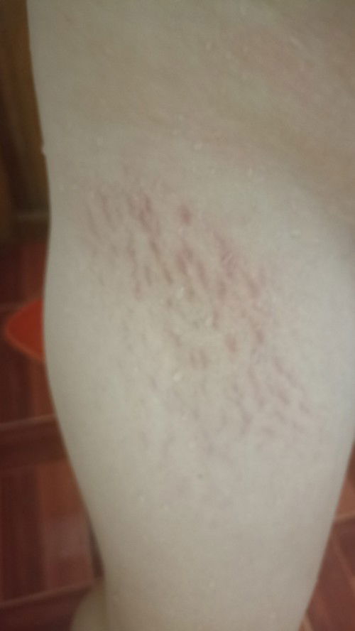 น่องแตกลาย