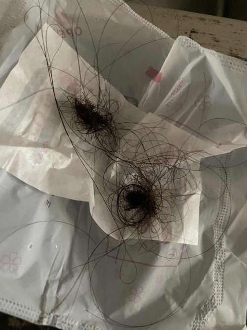 Rambut rontok parah