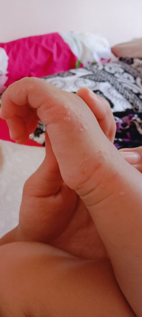 Bintik berair dan gatal.