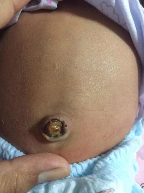 สะดือน้องพึ่งหลุดวันนี้