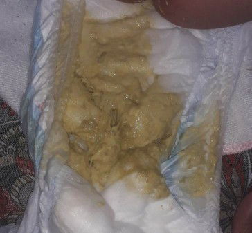 Normal lang po ba yung ganitong poop sa Nan AL 110