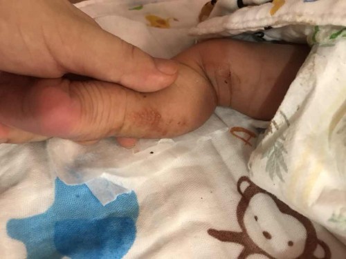 Bé được 4 ngày tuổi, chân của bé bị nổi những mụt li ti nhỏ, vậy bé có vấn đề gì ko ạ?