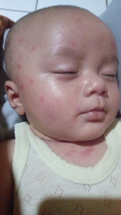 Merah merah tiba tiba di bagian muka dan leher kira kira alergi atau apa ya mom?