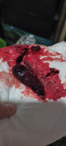 Miscarriage po ba ito?
