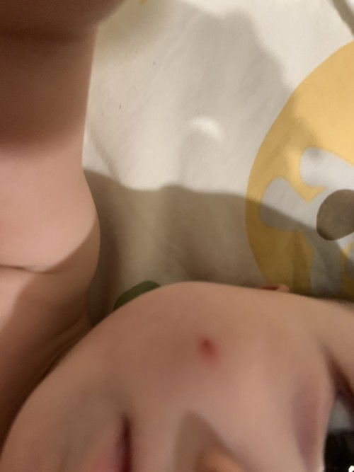 เป็นแผลผองๆ