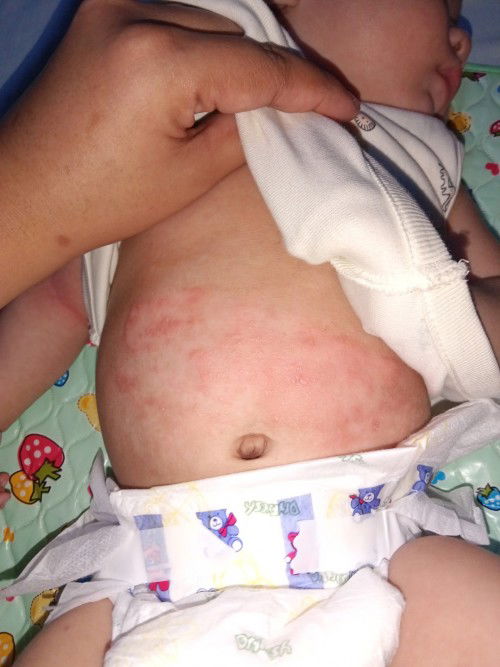 Rashes sa tyan ni baby