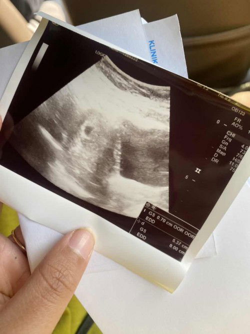 Pendarahan disekitar kantung hamil