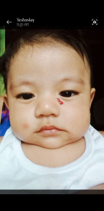 Hemagioma 4months 7 days baby