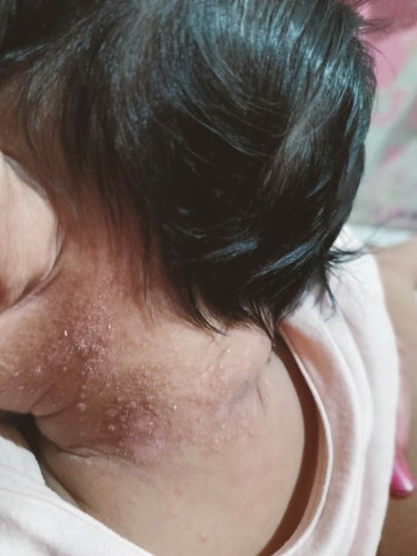 skin rashes?