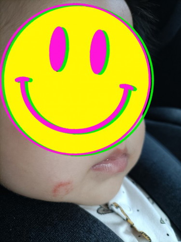 Red patch on face