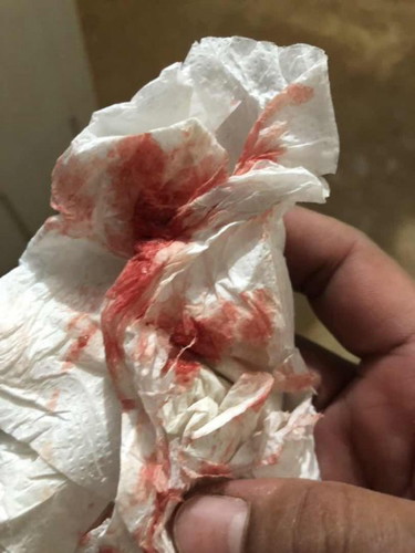 มีมูกเลือดออกเหมือนประจำเดือนท้อง40week