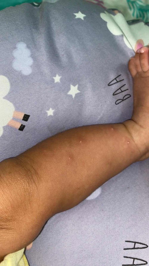 Bentol2 berair dan menghitam pada bayi