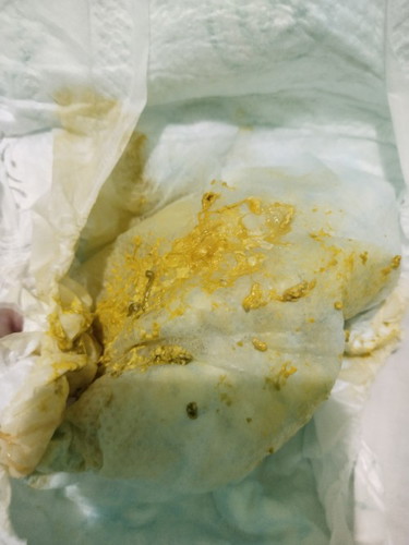 Poop of newborn