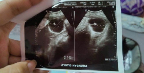 Cystic hygroma