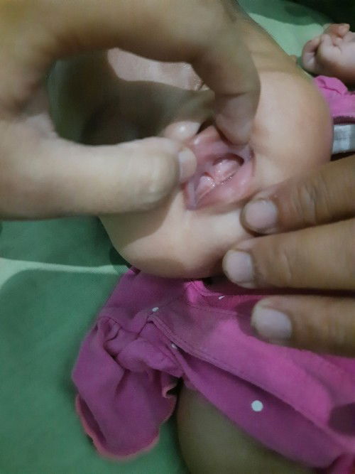 Lip tie bayi 3 bulan