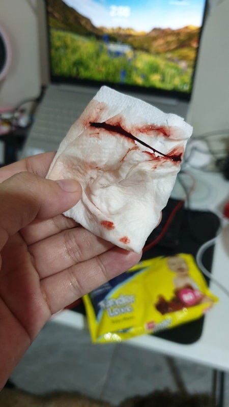 May kunting blood lumabas