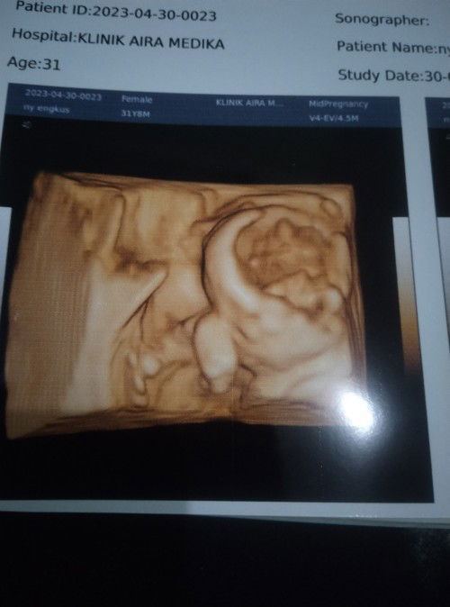 USG 4d pas usia kandungan 20week valid gak?