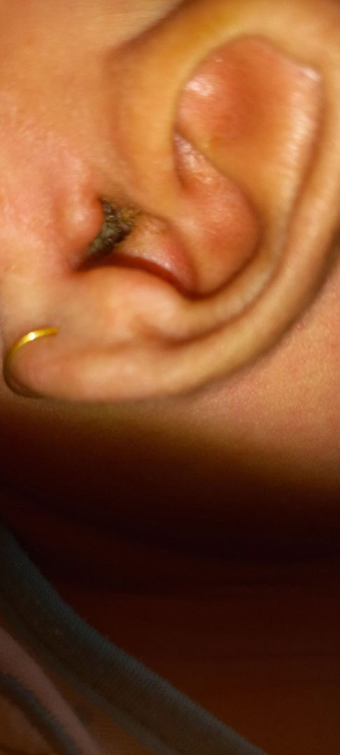 Masalah kuping pada bayi 1 bulan