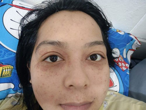 สอบถามค่ะ ตั้งครรภ์ ได้11w5d  ขึ้นผื่นเม็ดแดงๆบริเวณใบหน้า