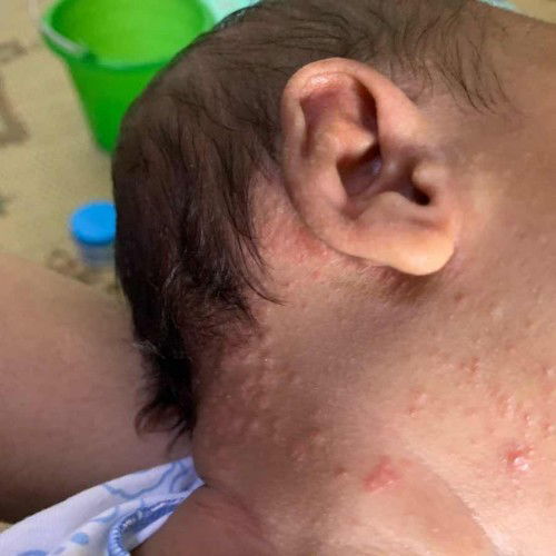 Ruam merah pada bayi