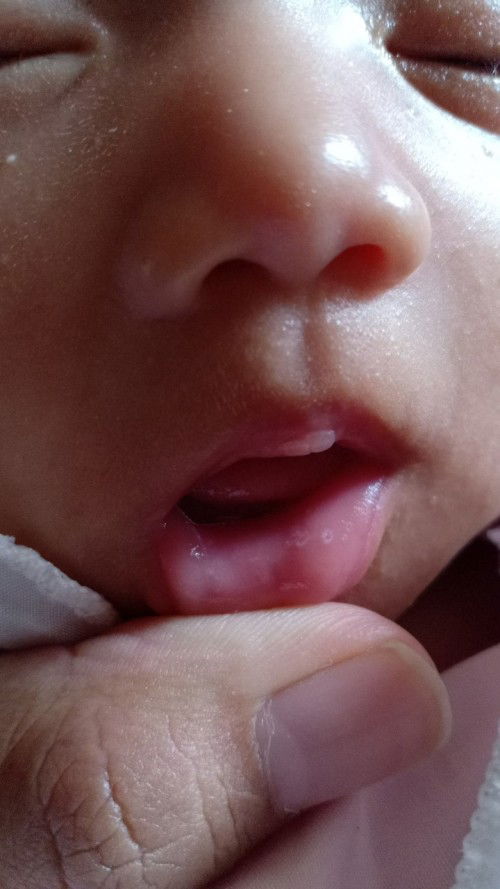 Mau izin tanya bun...kalo putih seperti ini, bekas susu atau sariawan yaa