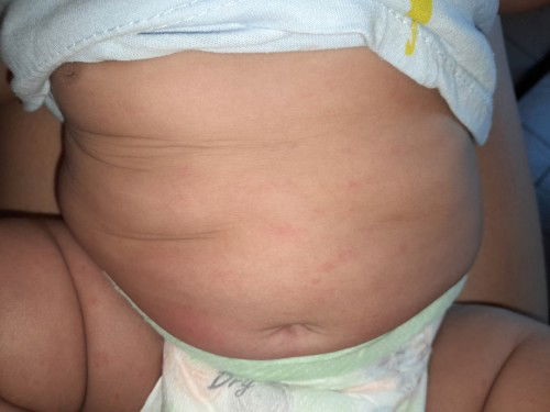 Baby redness sa tiyan