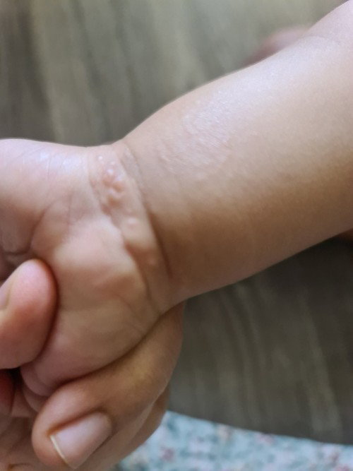 11 month pld got rash