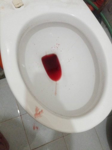Blood habang dumudumi.