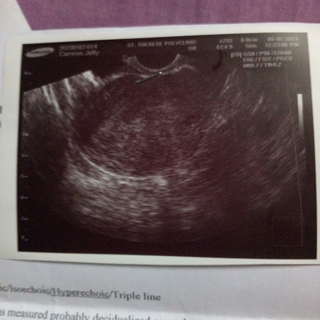 Sino po ba my same case sakin dito,6weeks,pero walang nakita kahit anino na my laman ang bahay bata.