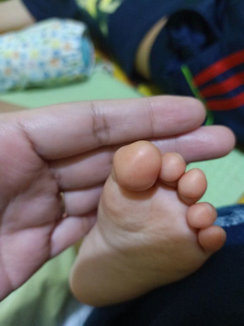 Carotenemia (kulit anak menjadi kuning)