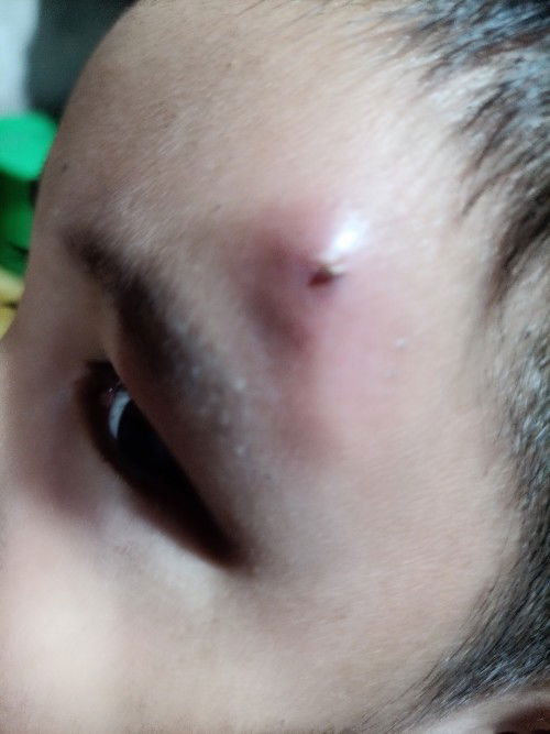 Prickly heat na biglang lumaki parang naging pigsa ???