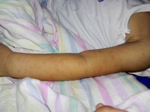 Ano po kaya magandang Gamot Dito?gawa lang po kaya sa init ito?sino po my same case ng ganito???????