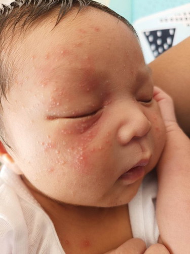 Anu po kaya gamot nyan mga mi 16days old palang po si baby, parang butlig po sya, dumami po