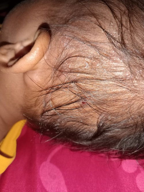 Benjolan belakang telinga