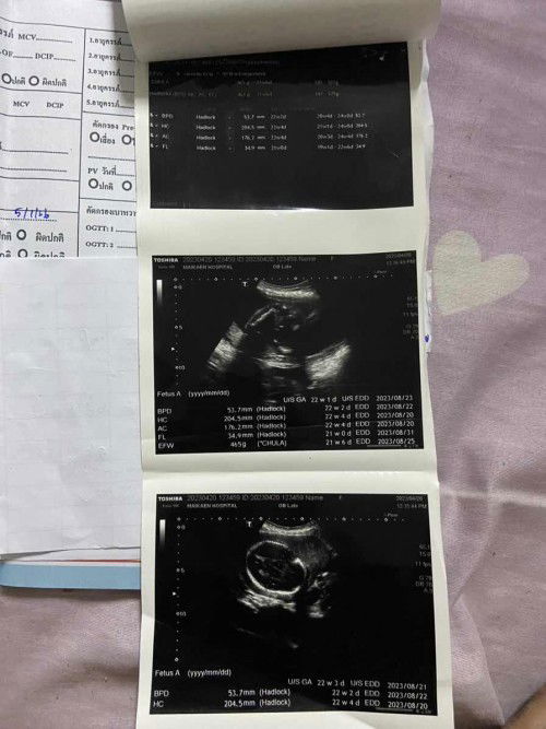 อัลตร้าซาวด์23week6day