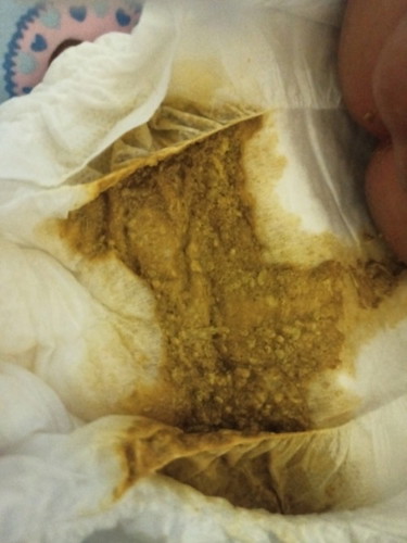 อึแลบนี้ท้องเสียมั้ย