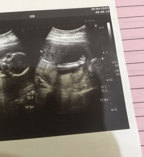 ท้องเเรกค่ะ 20วีค2วัน