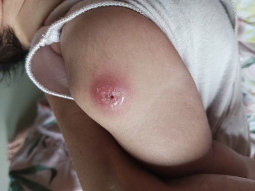 Bekas suntik imunisasi