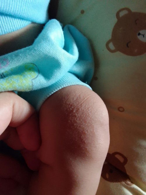 Bruntusan di area lutut