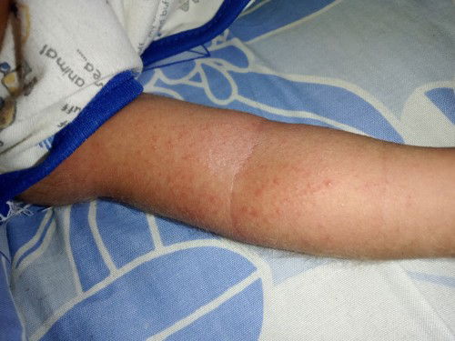 Sela kedua tangan dan leher kok ada bintik merah" kenapa ya? Apa karna keringat? Dikasih apa ya?