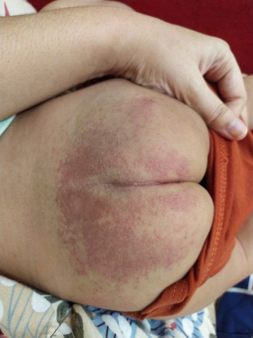 Ruam pantat bayi