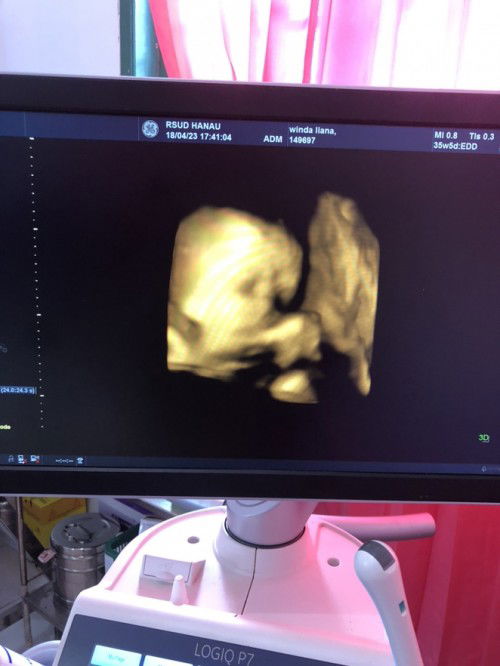 Usia kandungan 38minggu,bingung normal/sc