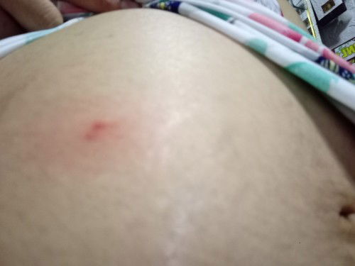 ano po kaya magandang pantanggal kati kati na safe para sa buntis