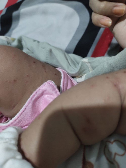 Bun mw tanya kulit bayi timbul bintik2 merah melepuh trus sebagian yg kering mlah jdi koreng