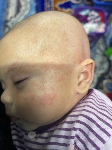 Anak  usia 2 bulan naikk kemerah merahannnn