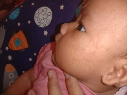 pipi bayi muncul bintik