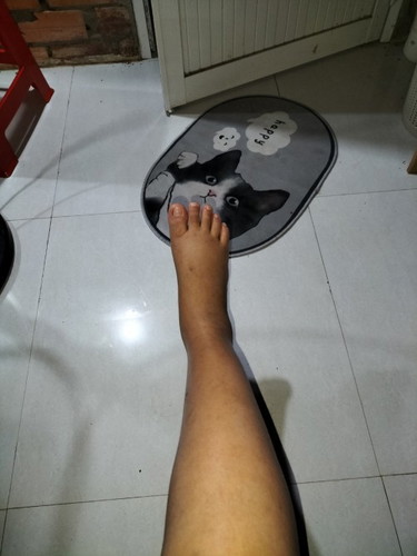 Bầu 36 tuần chân bị sưng có sau không ạ.có cách nào giảm sưng không ạ.
