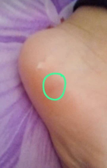 bintik dan benjolan kecil di kaki