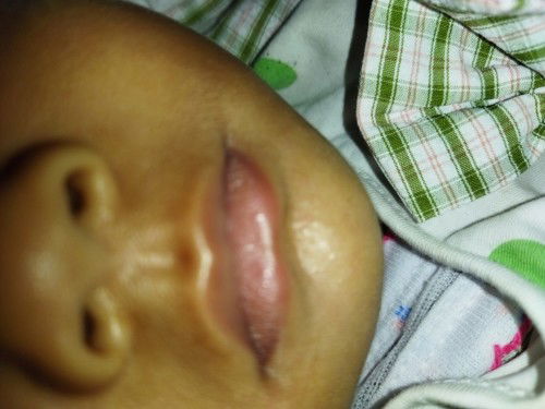 Apakah ini Alergi Sufor