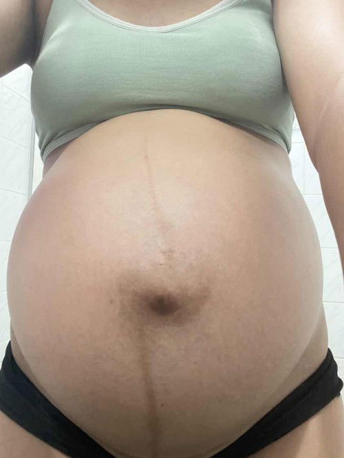 คลอดก่อนกำหนด